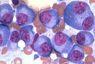 Myeloma cells cropped